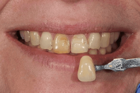 Restorative dental teeth